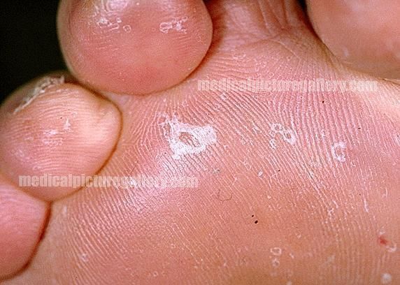 Tinea pedis